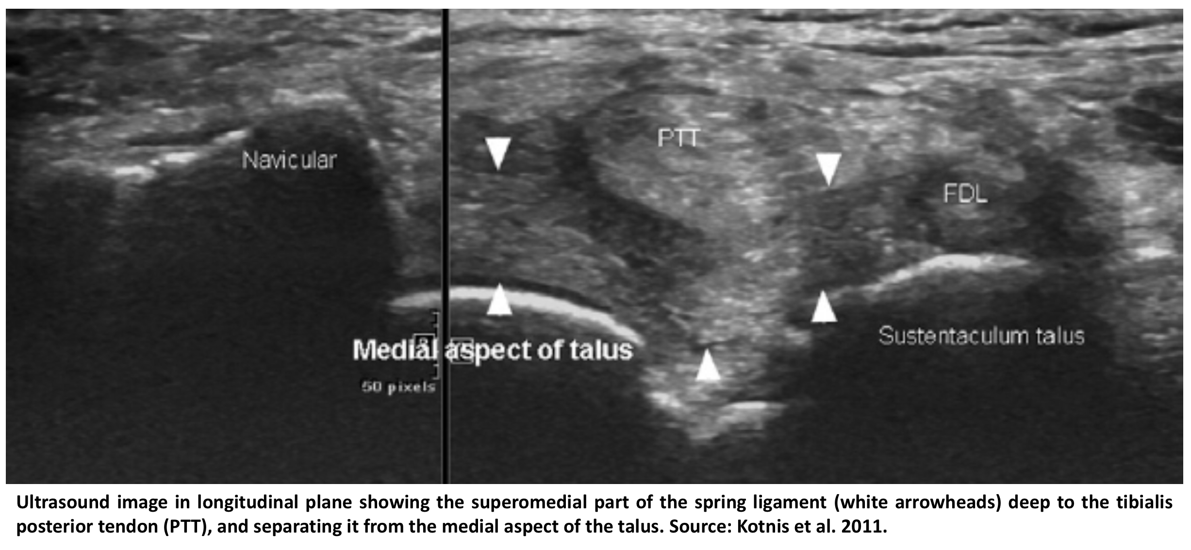 Anatomy, pathology and guideline for scanning the spring ligament in