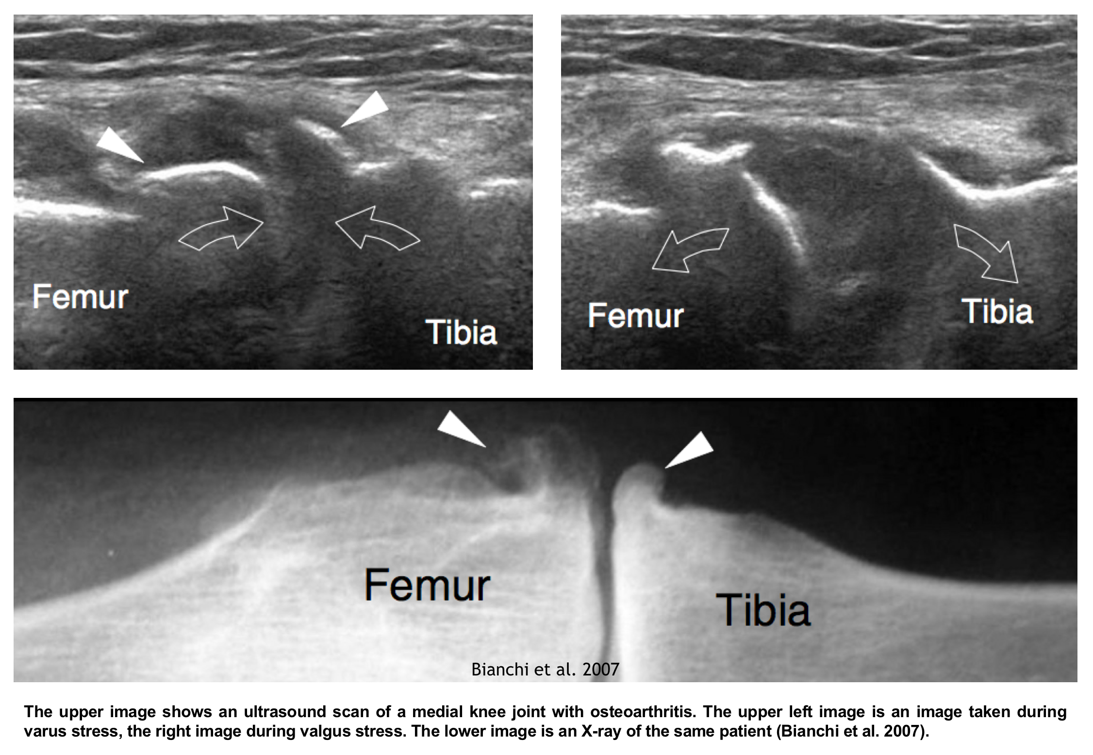 Ultrasound in knee osteoarthritis the added value